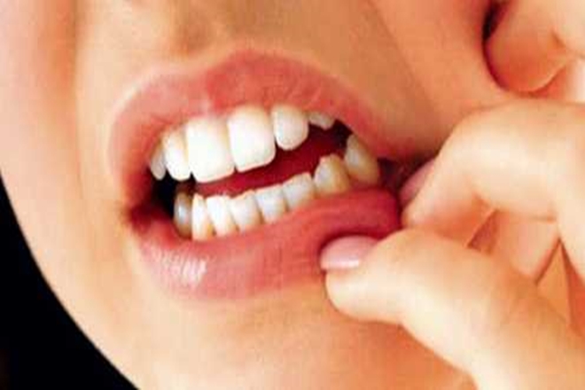Çekilen Diş Kanaması Nasıl Durdurulur