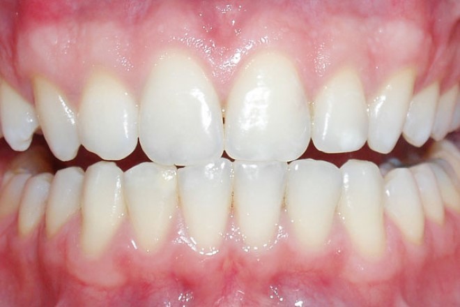 Dişlerimizde Renk Değişikliği Nasıl Önlenir? 2