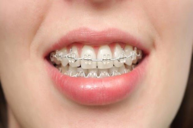 Diş Teli Nasıl Takılır? 1