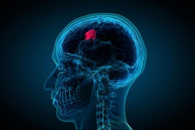 beyin tümörü nasıl anlaşılır 2