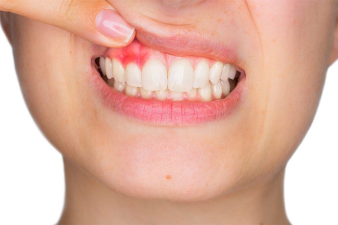 Diş Eti İltihabı Nasıl Geçer Diş Eti İltihabı Tedavi Yöntemleri 1